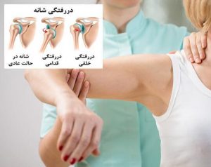دررفتگی مفصل شانه